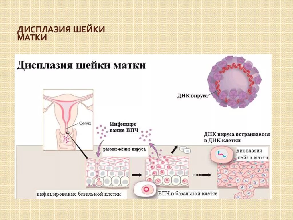 Умеренная дисплазия шейки матки что это. Дисплазия шейки матки классификация. Как выглядит дисплазия 1 степени. Дисплащиятшейки матки. ВПЧ дисплазия шейки матки.