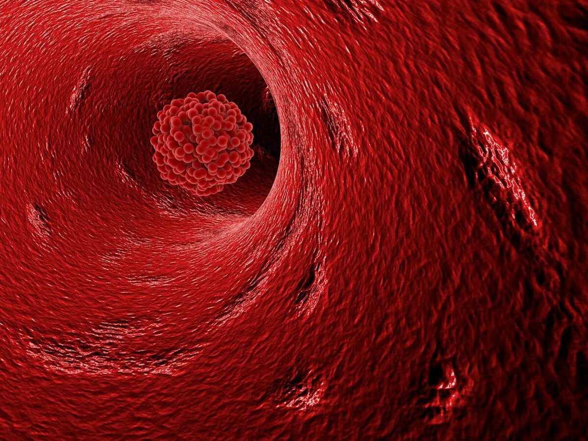 Тромбоз кровеносных сосудов. Тромб в кровеносном сосуде. Внутри кровеносного сосуда. Тромбоз без флотации