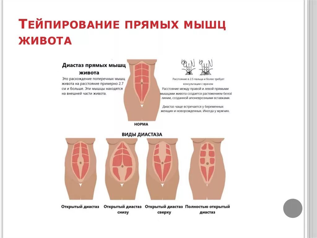 Схемы тейпирования при диастазе прямых мышц живота. Тейпирование диастаза живота схема. Схема тейпирования живота при диастазе. Тейпирование живота при диастазе схема.