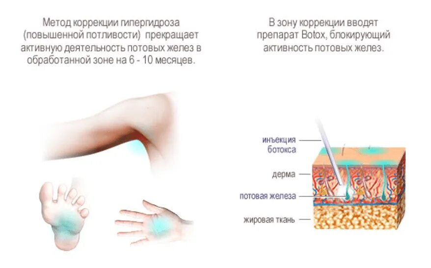 Схема инъекций при гипергидрозе. Схема введения ботулотоксина в подмышки. Причина потовыделения у мужчин