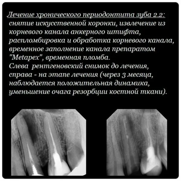 Пломбирование корневых каналов кальцием. Пломбирование зуба метапексом. Метапекс временное пломбирование. Метапекс в стоматологии. Лекарство в зуб Метапекс.