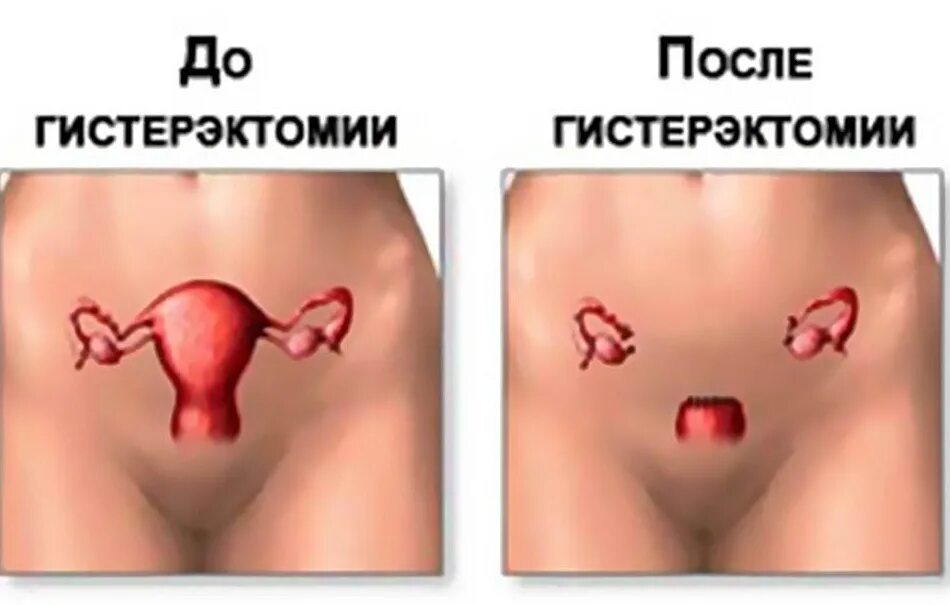 Удаление матки и половая жизнь. Как выглядит матка после удаления. Лапаротомическая гистерэктомия.