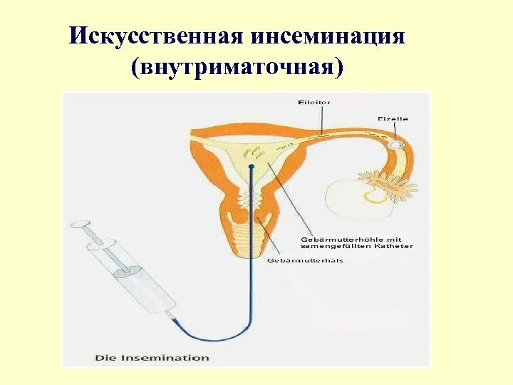 Искусственное введение семени. Инсеминация сперматозоидов. Искусственная инсеминация этапы. Гетерономная инсеминация. Внутриматочная инсеминация вми (искусственная).