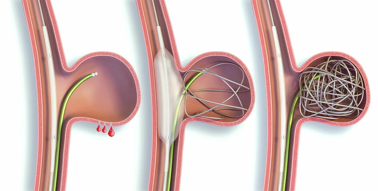Аневризма головного мозга эндоваскулярным. Эндоваскулярная эмболизация головного мозга. Эндоваскулярная эмболизация аневризм сосудов головного мозга.. Эндоваскулярная окклюзия аневризм сосудов. Эмболизация аневризмы сосудов.