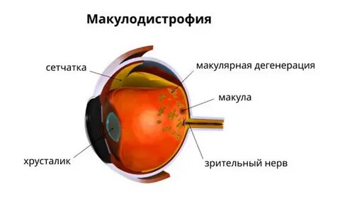 Уколы при дистрофии сетчатки