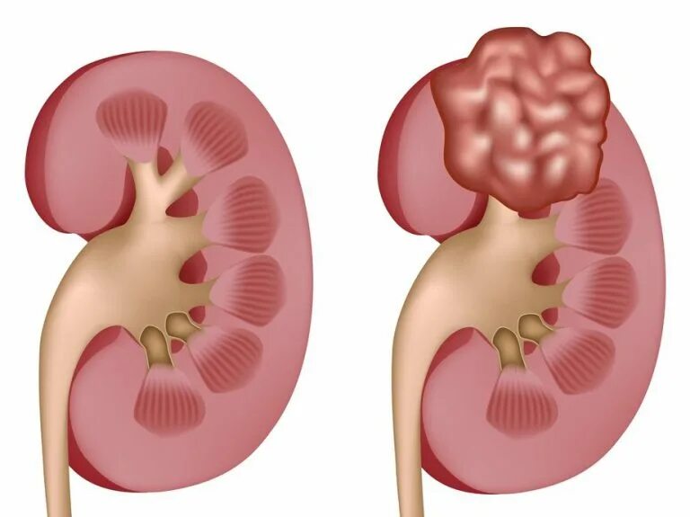 Рак почки причины. Острый нефрит пиелонефрит. Злокачественная опухоль почки.