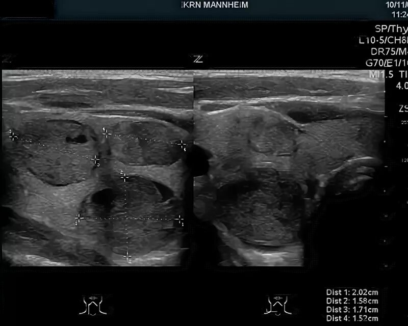 узи узлового зоба. ультразвуковая диагностика узлового зоба. узи узлового зоба. узи щитовидной железы заключение узловой зоб. узи щитовидной железы сонограмма.