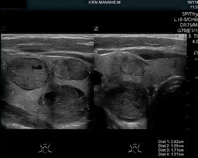 Узи зоб. УЗИ картина узлового зоба. Узловой коллоидный зоб УЗИ.