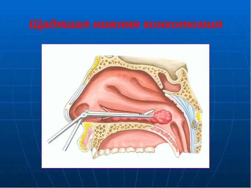 Что такое хронический ринит. Конхотомия нижних носовых раковин. Хирургическая вазотомия носовых раковин. Гипертрофический ринит. Щадящая конхотомия нижних носовых раковин.