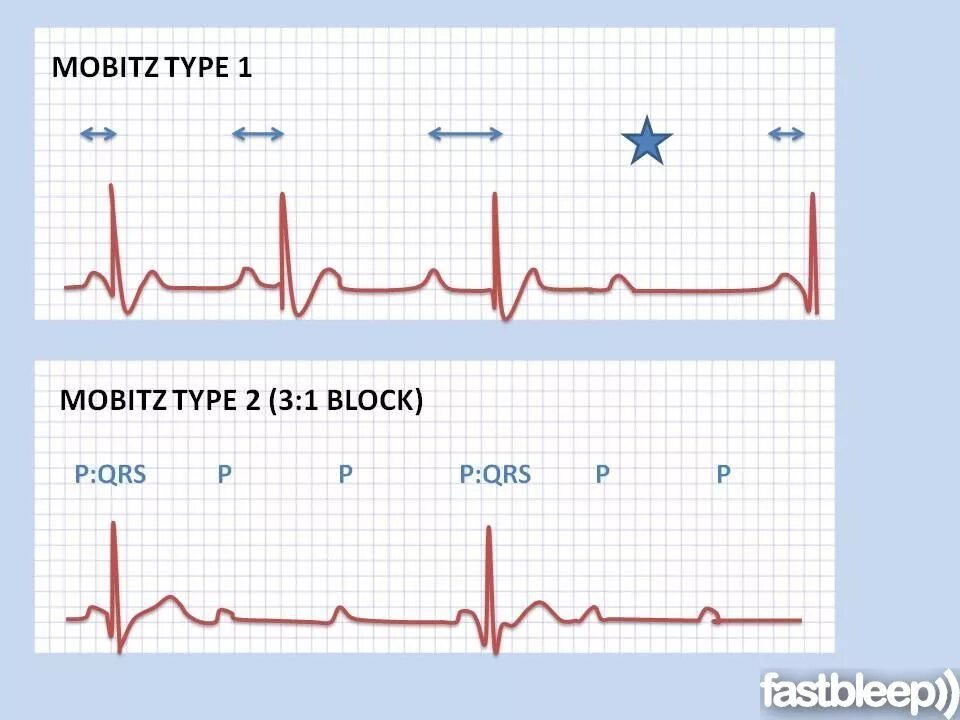 Av Block EKG. Av Block ECG 2 degree. 3rd degree av Block ECG. ECG av Block 3. Av блок