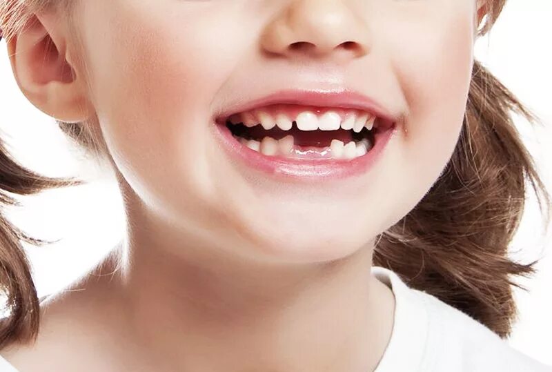 Как отличить молочный зуб. Молочные зубы у детей. Кривые зубы у детей девочек.