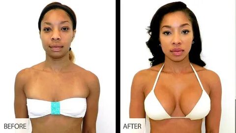 Virgin tightening surgery before and after pics.