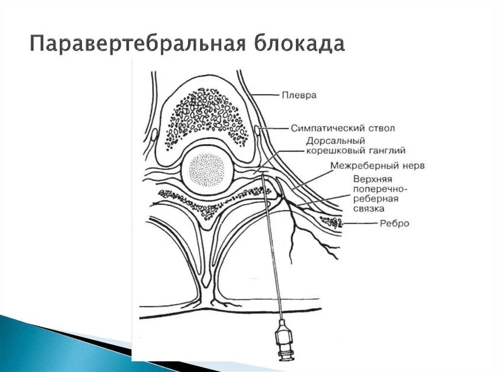 Паравертебральная поясничная блокада. Паравертебральная блокада грудной отдел техника. Техника выполнения паравертебральной блокады поясничного отдела. Техника проведения паравертебральной блокады. Паравертебральная блокада пояснично-крестцовый техника выполнения.