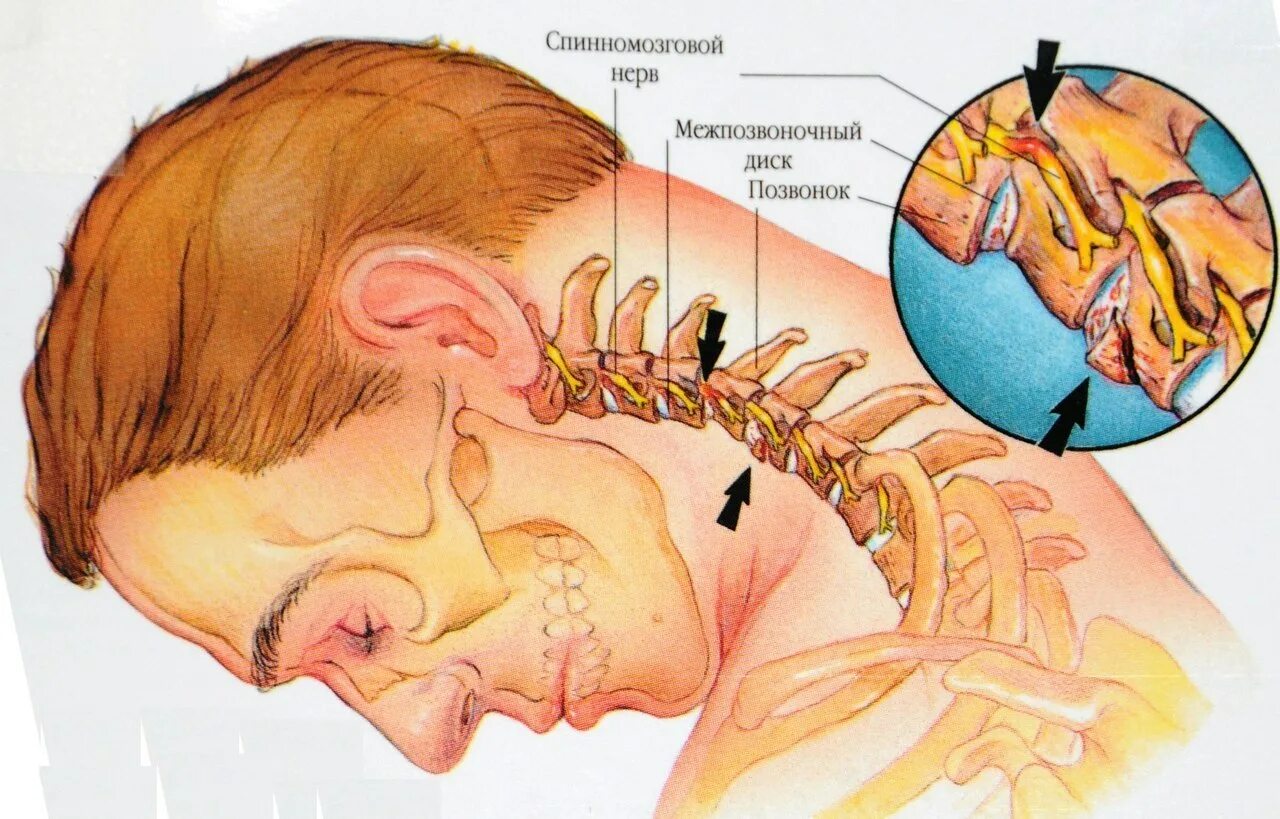 Почему давит на уши. Шейный остеохондроз. Защемление нерва в шейном. Остеохондроз шейного отдела.