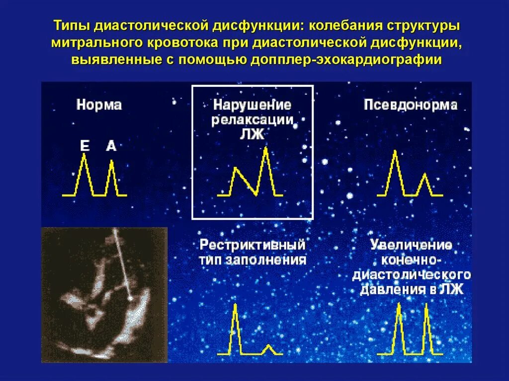 Диастолическая дисфункция левого желудочка 1 типа по ЭХОКГ. Нарушение диастолической функции типы. Диастолическая дисфункция левого желудочка на ЭХОКГ. Типы диастолической дисфункции ЭХОКГ.