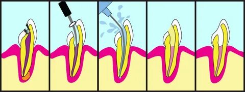 How to save tooth endodontist 23228? 