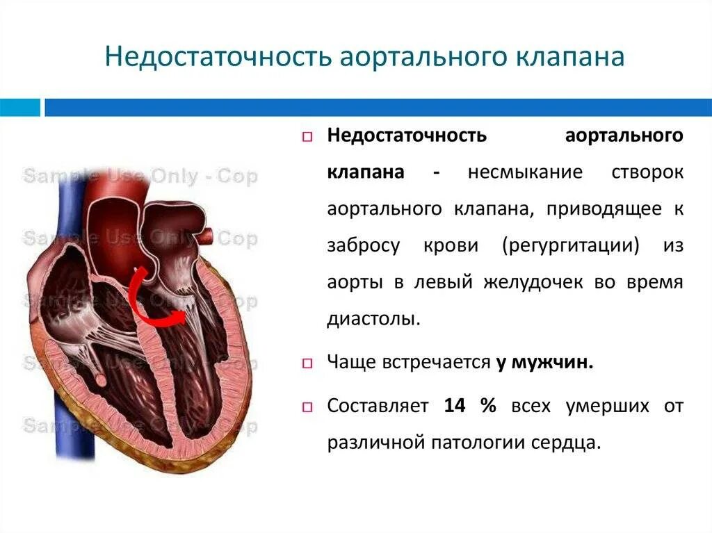 Регургитация аортального клапана степени. Недостаточность створок аортального клапана 1 степени. Врожденная недостаточность аортального клапана 1 степени. Уплотненные створки аортального клапана. Сердечная недостаточность митрального клапана