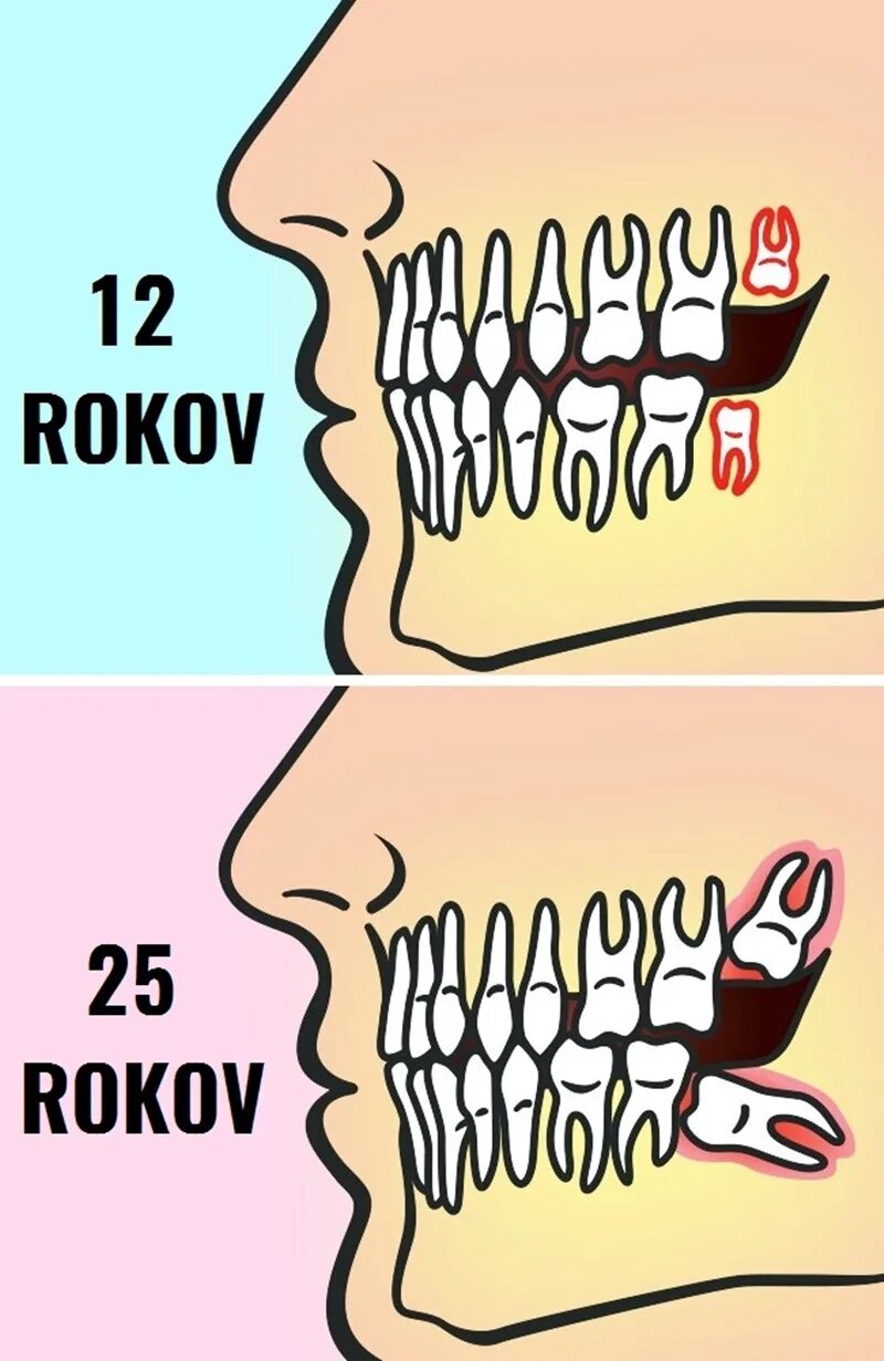 Сколько зубов мудрости может быть у человека. Удалённый зуб мудрости. Зуб мудрости правильное расположение.