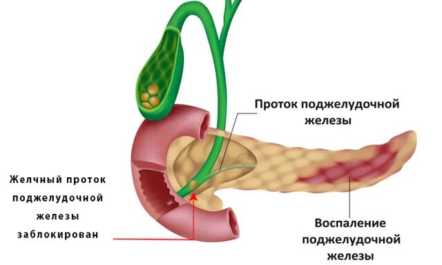 Лечение поджелудочной желчного пузыря. Панкреатический проток поджелудочной железы. Проток поджелудочной железы и желчный проток. Что такое вирсунгов проток в поджелудочной железе.