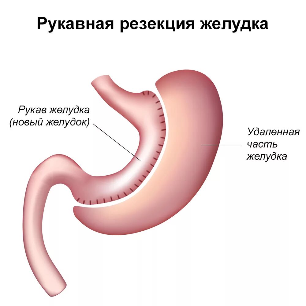 продольная резекция желудка слив sleeve. продольная (рукавная) резекция желудка. лапароскопическая продольная резекция. рукавная гастропластика. бариатрическая хирургия резекция желудка.