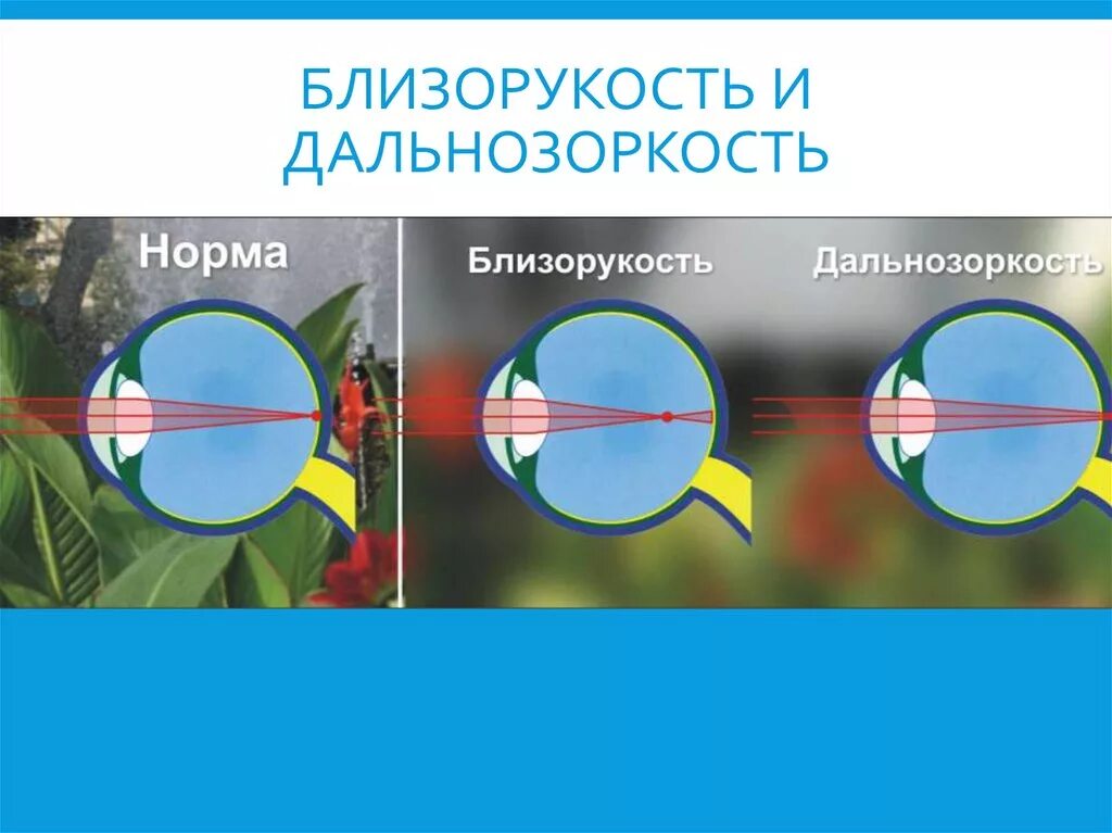 Видят в ней абсолютный. Близорукость и дальнозоркость. Норма близорукость дальнозоркость. Миопия и дальнозоркость. Миопия и гиперметропия.