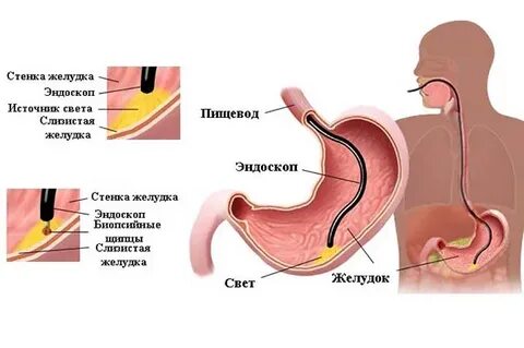 Кома желудка