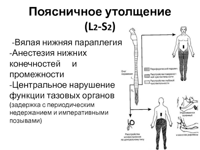 Парез верхних конечностей. Симптомы поражения поясничного утолщения. Нижний Центральный парапарез возникает при поражении. Нижний спастический парапарез синдромы. Центральный парапарез нижних конечностей.