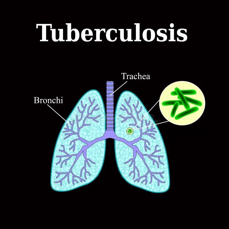 Tuberculosis disease. Микобактерия туберкулеза. Tuberculosis disease. Tuberculosis ава. Заболевания органов дыхания туберкулез.