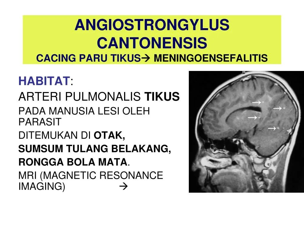 Нематода ангиостронгилез. Мозговой червь angiostrongylus. Angiostrongylus cantonensis у человека. Паразит angiostrongylus cantonensis. Angiostrongylus cantonensis слизняк.
