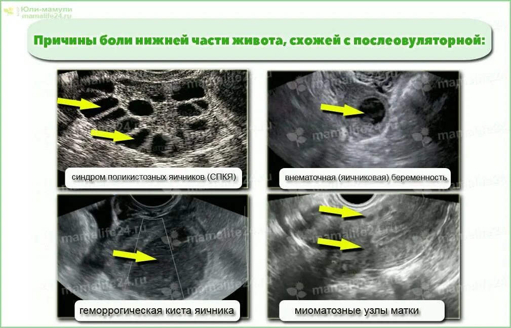 Почему болит яичник при овуляции. Рези в яичниках причины. боль в яичнике при овуляции. болит киста в яичник при овуляции. боли при овуляции в левом яичнике.