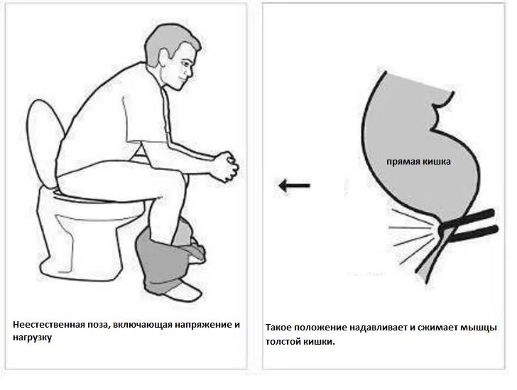 Правильная поза для дефекации. Поза для правильного хождения в туалет. Правильная поза для туалета. Правильная поза для туалета по большому. Почему нельзя сидеть в туалете