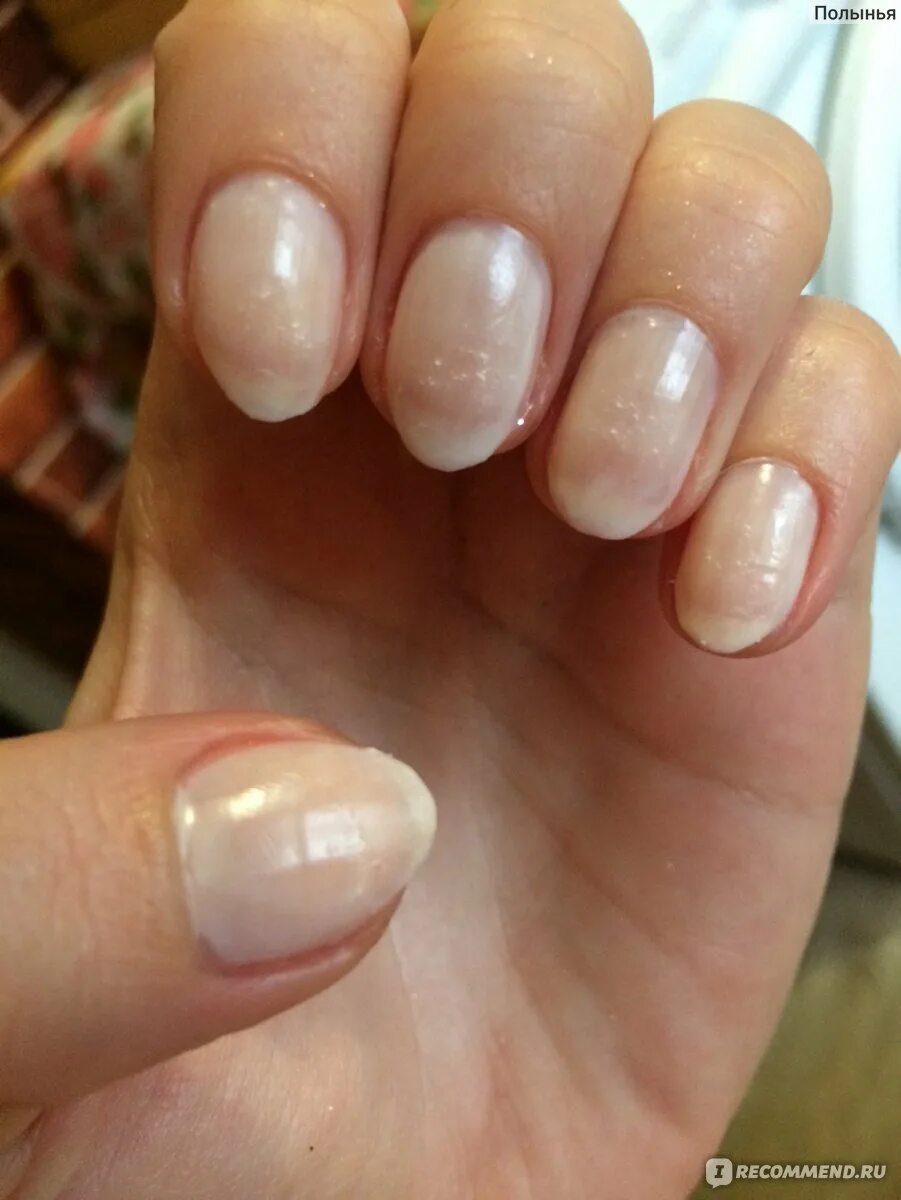 Ожог лампой гель. Ожог от гель лака для ногтей лампы. Химический онихолизис. Ожог лампой гель. Аллергия на уф лампу для ногтей.