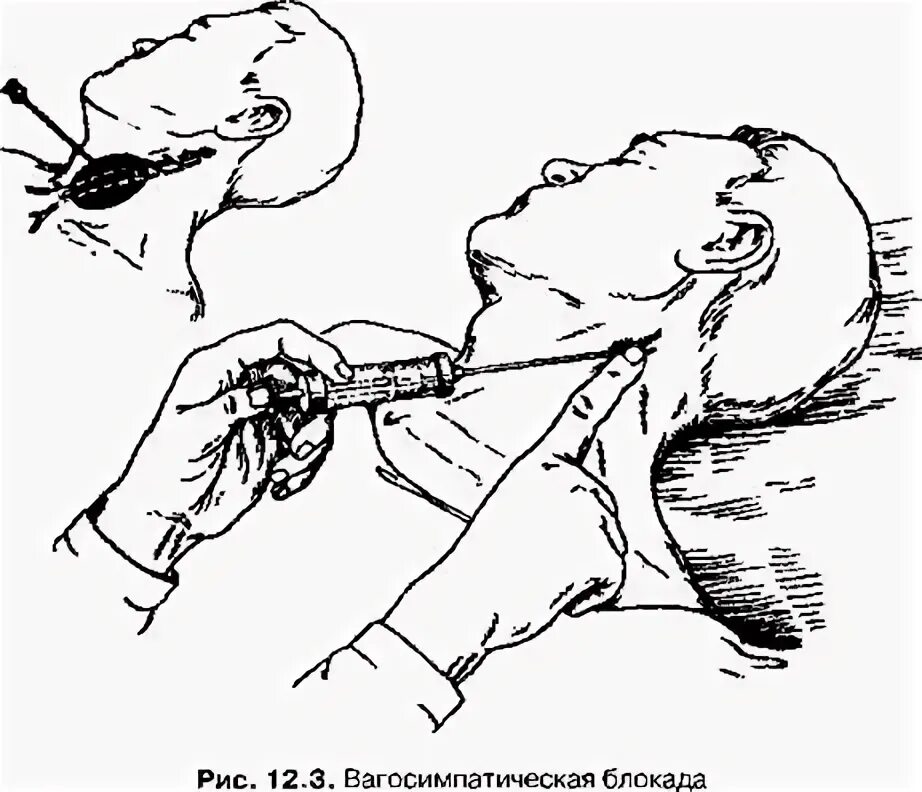 Блокада в шею. Шейная вагосимпатическая блокада техника. Вагосимпатическую блокаду по Вишневскому. Вагосимпатическая блокада показания. Вагосимпатической блокады по а.в. Вишневскому.