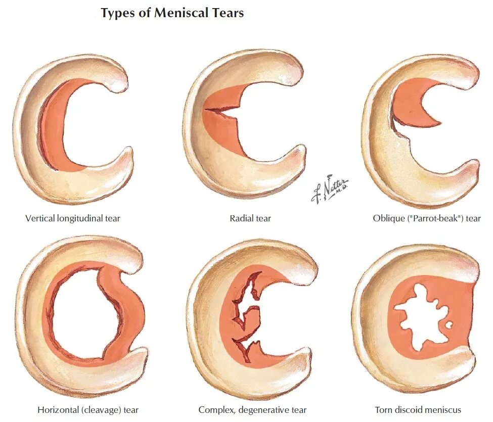 Косо горизонтальный разрыв медиального мениска 3 степени. Разрыв заднего рога мениска мениск коленного сустава. Задний Рог медиального мениска 3 степени. Повреждениезаднего рога медиалтного мениска 3а степени. Степени повреждения мениска коленного сустава по stoller