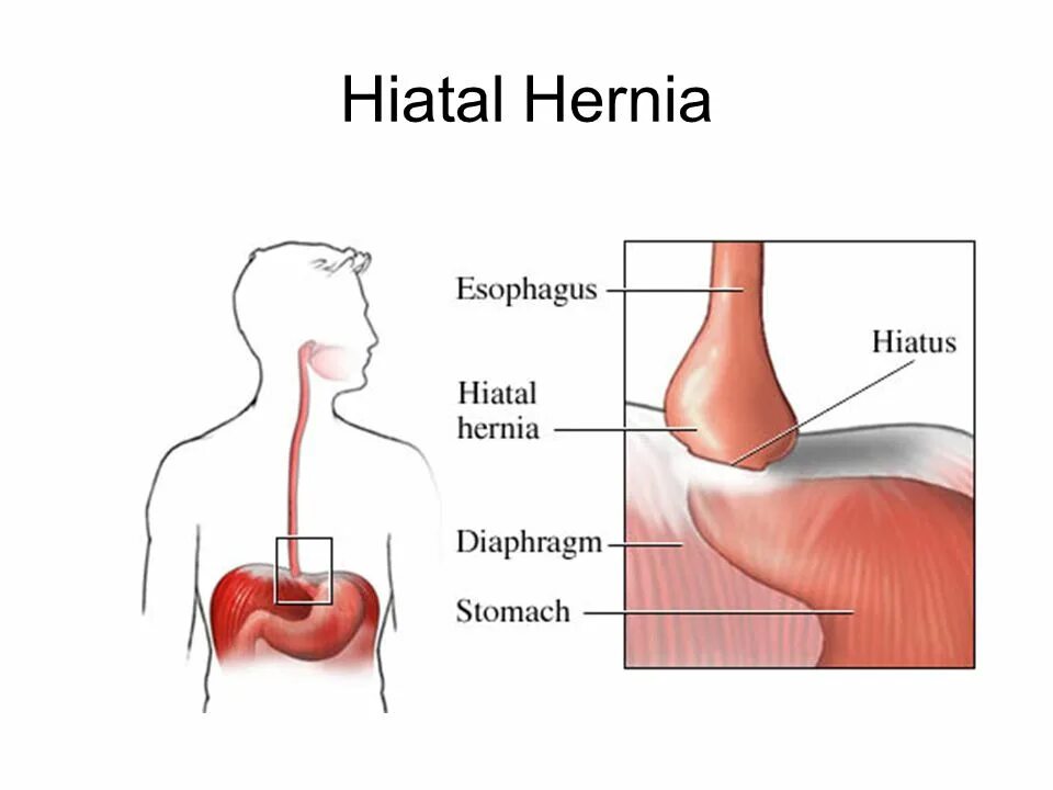 Стенд пищевода. Пищеводная грыжа пищеводного отверстия диафрагмы. Грыжа пищевода отверстия диафрагмы. Грыжа диафрагмального отверстия пищевода. Грыжа пищеводного отверстия пищевода симптомы.