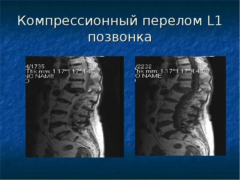 Компрессионный перелом тела l3 позвонка. Перелом грудного позвонка рентген. Компрессионные переломы тел th 12,l1 позвонков. Компрессионный перелом позвоночника т11. Консолидирующий перелом позвоночника.