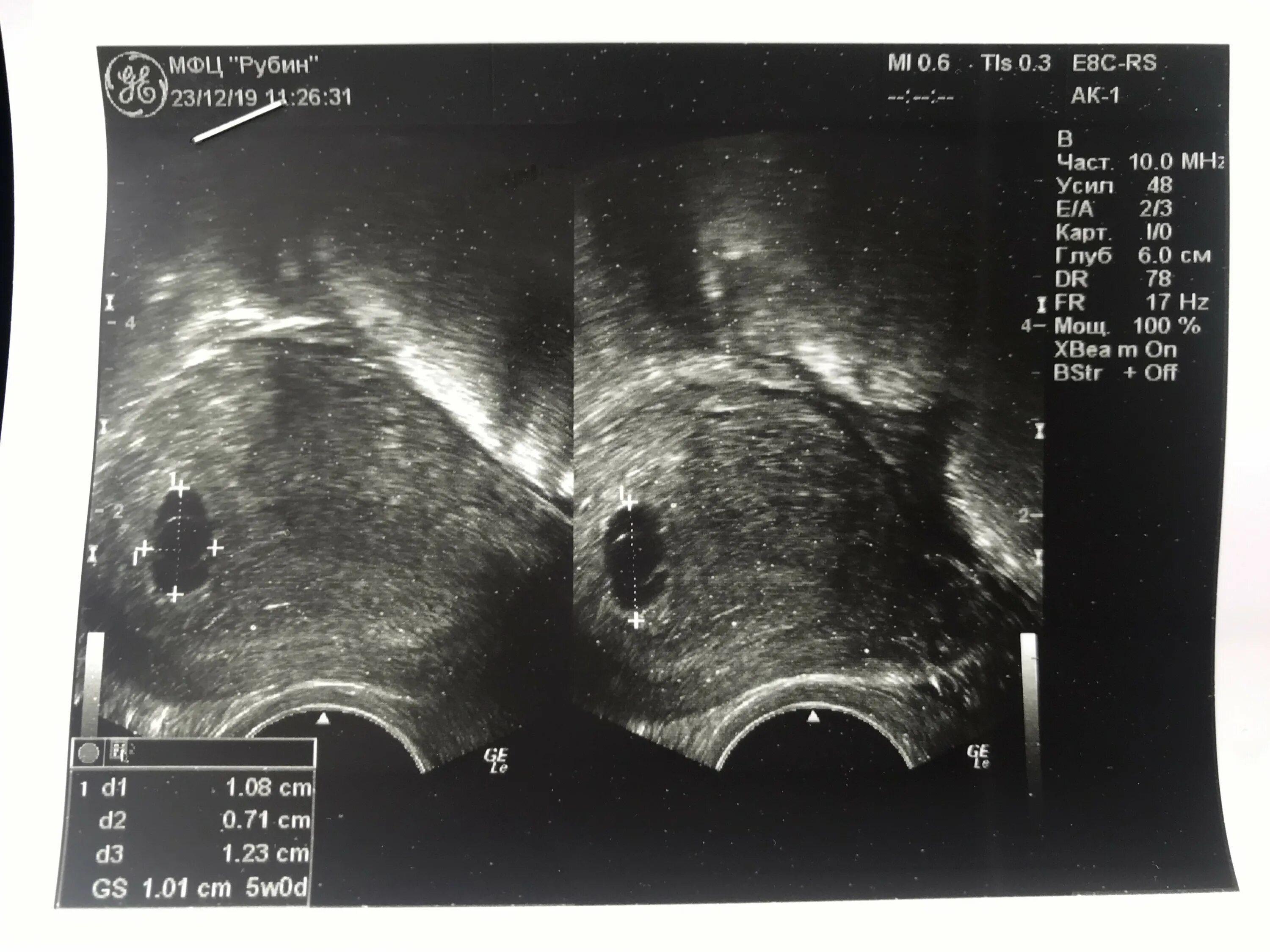 Остатки плодного яйца УЗИ. Два плодных яйца на УЗИ форум. Узи 5 недель не видно эмбриона