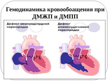 Гемодинамика межжелудочковой перегородки