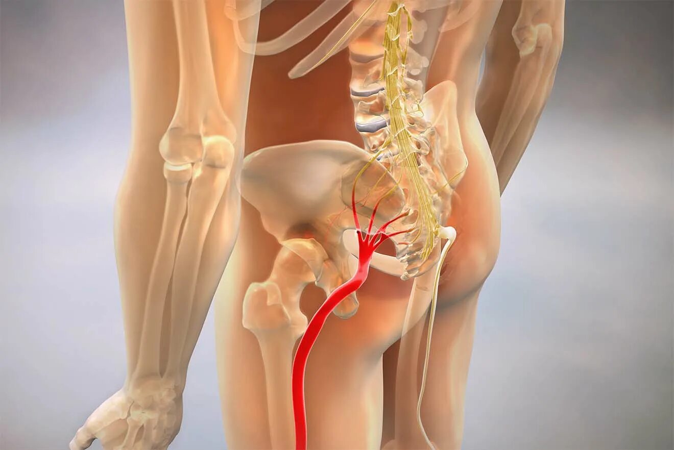 Сильные боли в области таза. Ишиас седалищного нерва. Воспаление седалищного нерва. Седалищный нерв анатомия. Ишиас - защемление седалищного нерва.