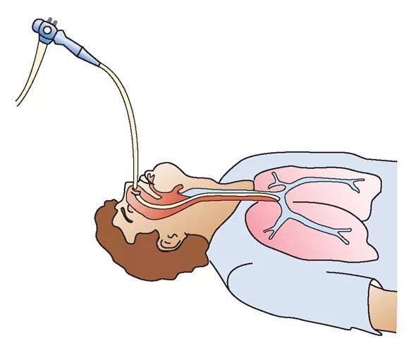 Санация трахеобронхиального дерева. Бронхоскопический лаваж. Санация трахео-бронхиального дерева. Бронхоскопия кровохарканье. В легкие через нос