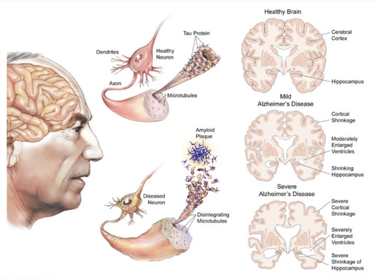 Brain disease. Этиопатогенез болезни Альцгеймера. Механизм развития Альцгеймера. Болезнь Альцгеймера патогенез. Болезнь Альцгеймера локализация поражения.