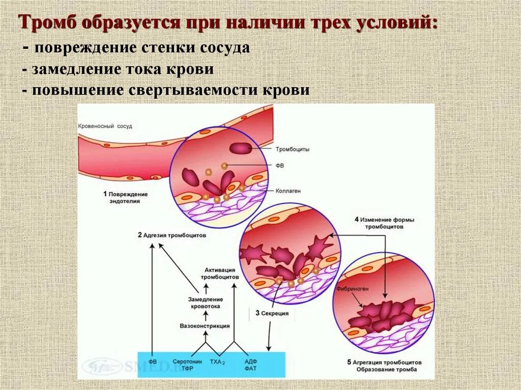 Схема образования тромба. Процесс образования тромба. Условия образования тромба. Размеры тромбов