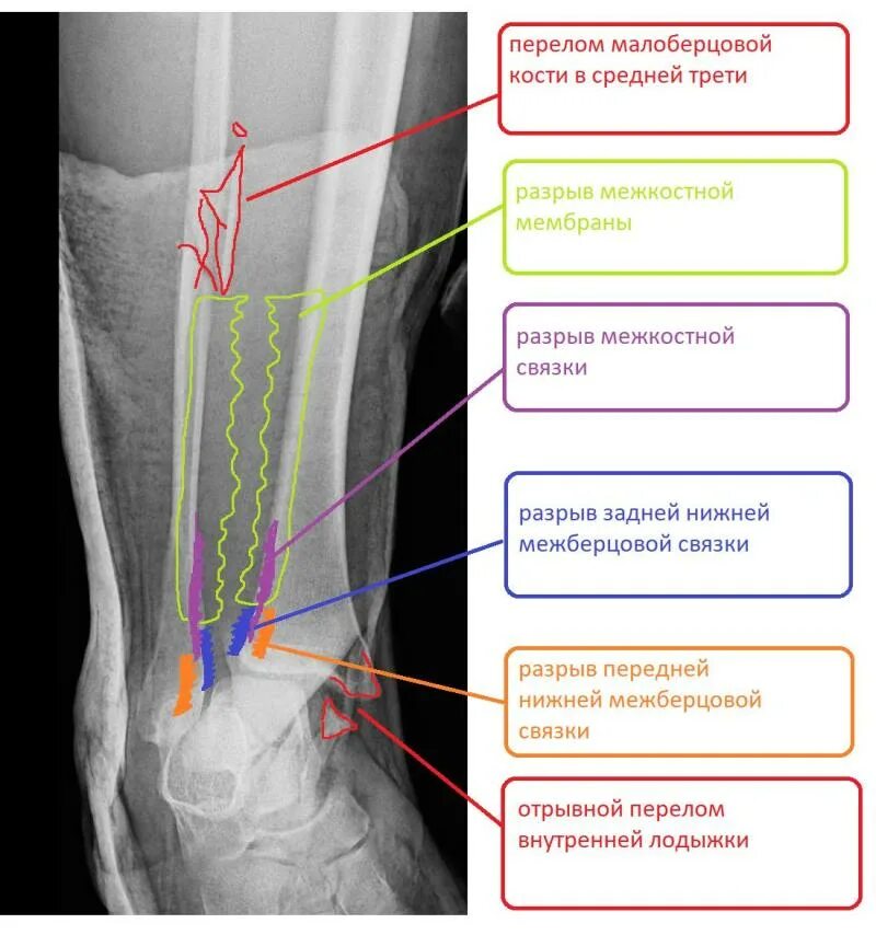 Дистальный разрыв. Дистальный синдесмоз голени. Перелом лодыжки синдесмоз. Разрыв дистального межберцового синдесмоза рентген. Перелом латеральной лодыжки малоберцовой кости.