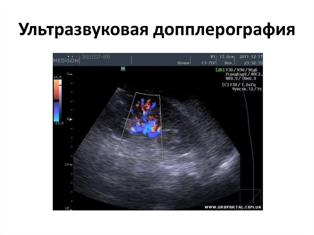 Что такое уздг. Ультразвуковая допплерография почечных вен. УЗИ почек допплер сосудов почек. УЗДГ допплерография печени. УЗИ допплерография сосудов печени.
