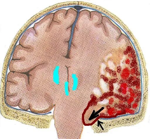 Что значит очаг в головном мозге. Контузионный очаг в головном мозге. Субдуральное кровоизлияние головного мозга. Субдуральная гематома на кт. Субдуральная гематома головного мозга.