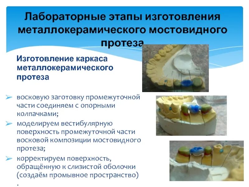 Лабораторные этапы изготовления мостовидного протеза. Клинико-лабораторные этапы мостовидных протезов. Этапы изготовления металлокерамического протеза. Клинико лабораторные этапы изготовления мостовидного протеза. Лабораторные этапы металлокерамической коронки