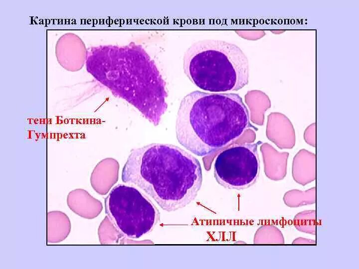 Тени Боткина Гумпрехта мазок крови. Клетки Боткина Гумпрехта это. Тениботкина гумперхта в крови. Клетки Боткина Гумпрехта лейколиза. Хронический лимфолейкоз кровь