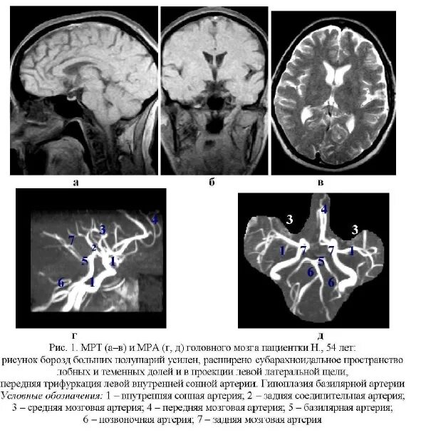 Задняя трифуркация внутреннецсонной артреии. Аплазия р1 сегмента правой задней мозговой артерии. Аплазия позвоночной артерии мрт. Гипоплазия мозговой артерии. Гипоплазия правых синусов