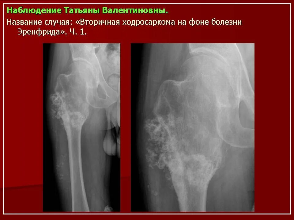 Саркома тазобедренного. Хондросаркома кости рентген. Саркома бедренной кости рентген. Костный экзостоз бедренной кости. Хондросаркома рентген бедренной.