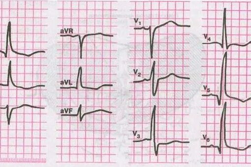 Вертикальная позиция сердца. Горизонтальная ось сердца на ЭКГ. Вертикальная ось на ЭКГ. ЭОС сердца на ЭКГ горизонтальная. Электрическая ось горизонтальная на ЭКГ что это.